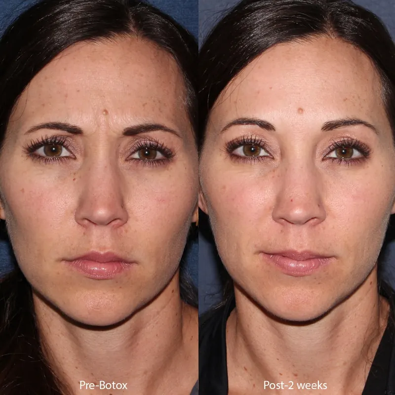 Botox for Frown Lines: Benefits, Risks & What to Expect