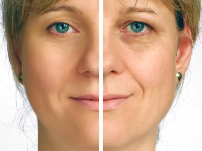 Botox Side Effects: What to Expect