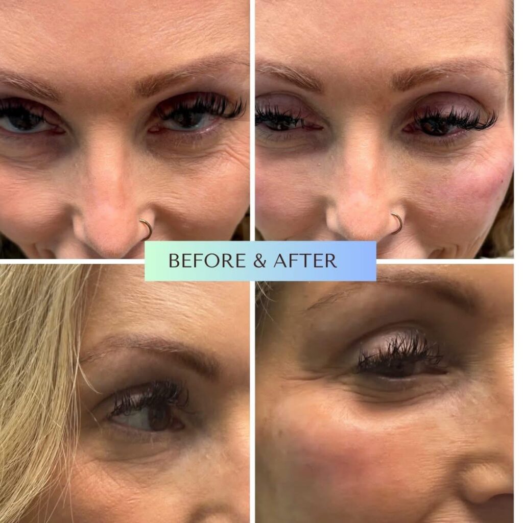 Before and after comparison of under-eye PRP treatment for natural rejuvenation of dark circles at Serene Med Spa.