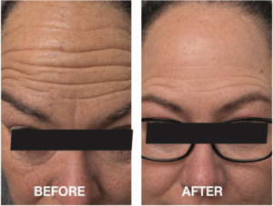 Botox Xeomin Before and After
